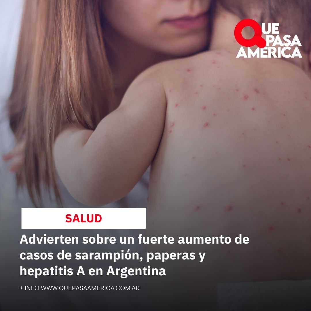 Advierten sobre un fuerte aumento de casos de sarampión, paperas y hepatitis A en Argentina