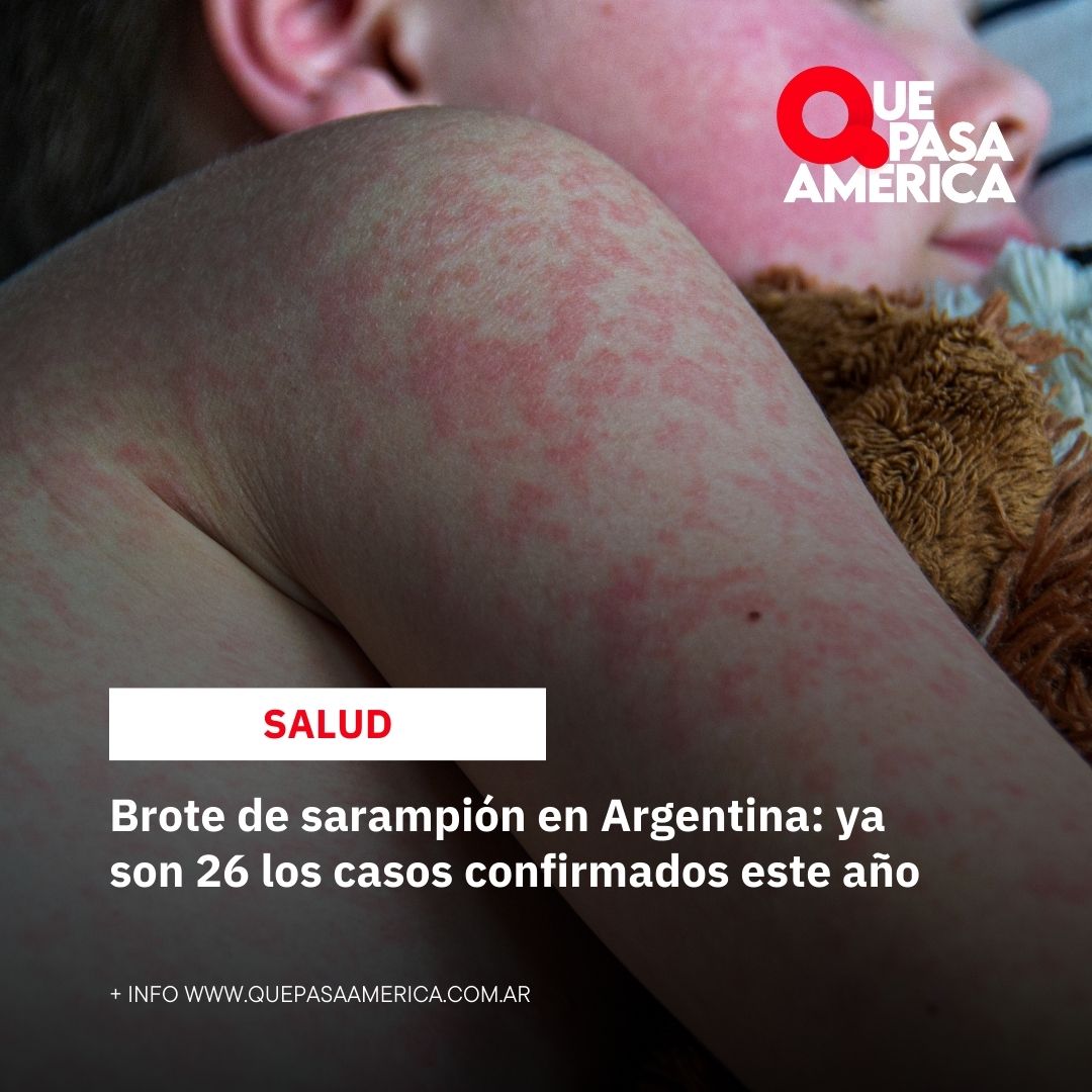 Brote de sarampión en Argentina: ya son 26 los casos confirmados este año