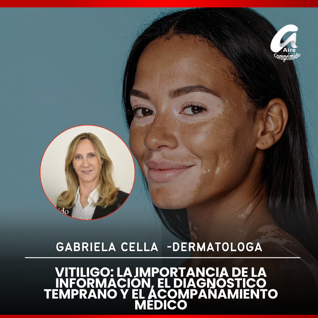 Vitiligo: la importancia de la información, el diagnóstico temprano y el acompañamiento médico