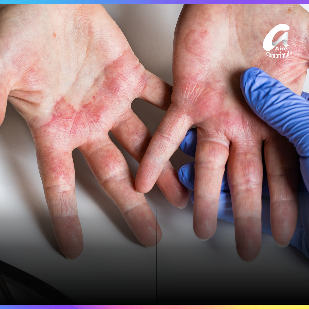 Dermatitis atópica: cómo reconocerla, qué puede desencadenar los brotes y por qué es importante consultar
